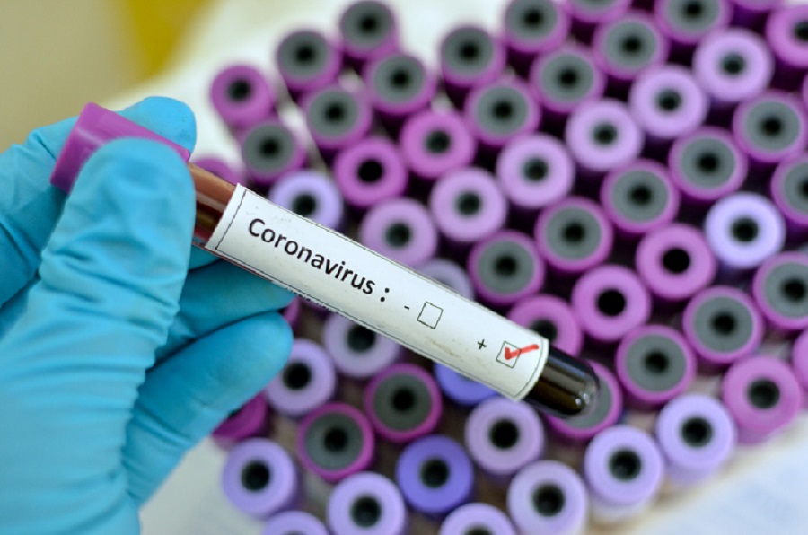 Leia mais sobre o artigo Número de infectados por coronavírus no Acre sobe para 17, segundo boletim