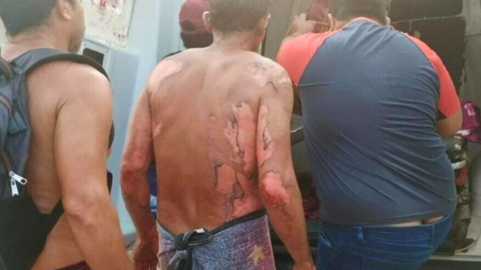 Leia mais sobre o artigo Homem sofre queimaduras em 60% do corpo após explosão de roçadeira