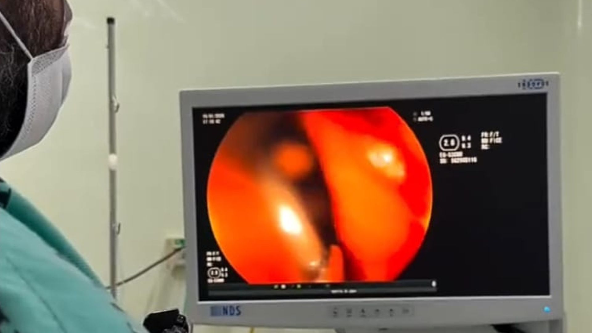 Leia mais sobre o artigo Hospital do Juruá retira prego do intestino de criança de 3 anos