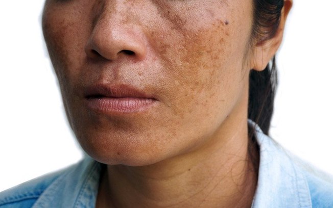 Leia mais sobre o artigo Melasma: como reconhecer e cuidar das manchas escuras que afetam a pele facial