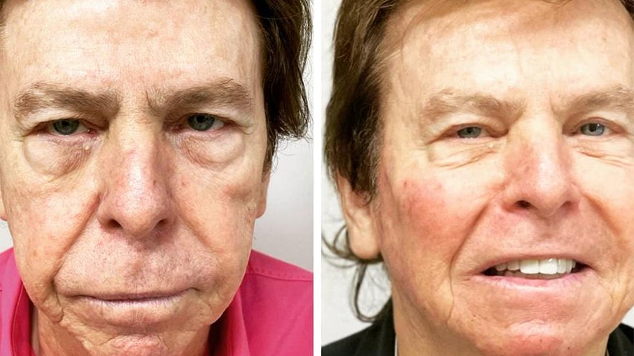 Leia mais sobre o artigo Nelson Rubens mostra resultado de harmonização facial: “Foram 19 injeções”