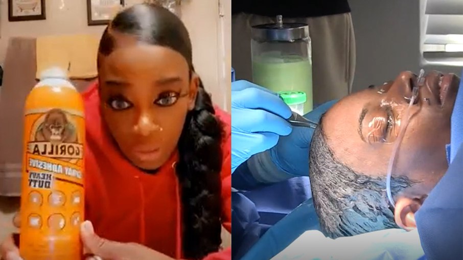 Leia mais sobre o artigo Influencer precisa ser operada após passar cola no cabelo ao invés de fixador