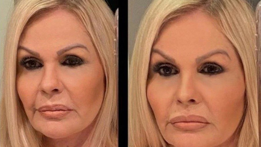 Leia mais sobre o artigo Monique Evans mostra antes e depois de harmonização facial