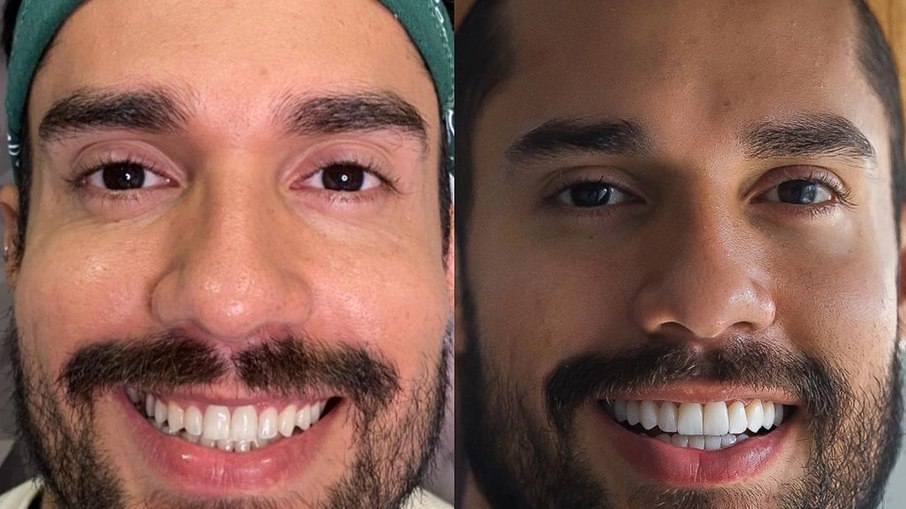 Leia mais sobre o artigo Ex-BBB Arcrebiano coloca lentes de porcelana nos dentes; veja o resultado